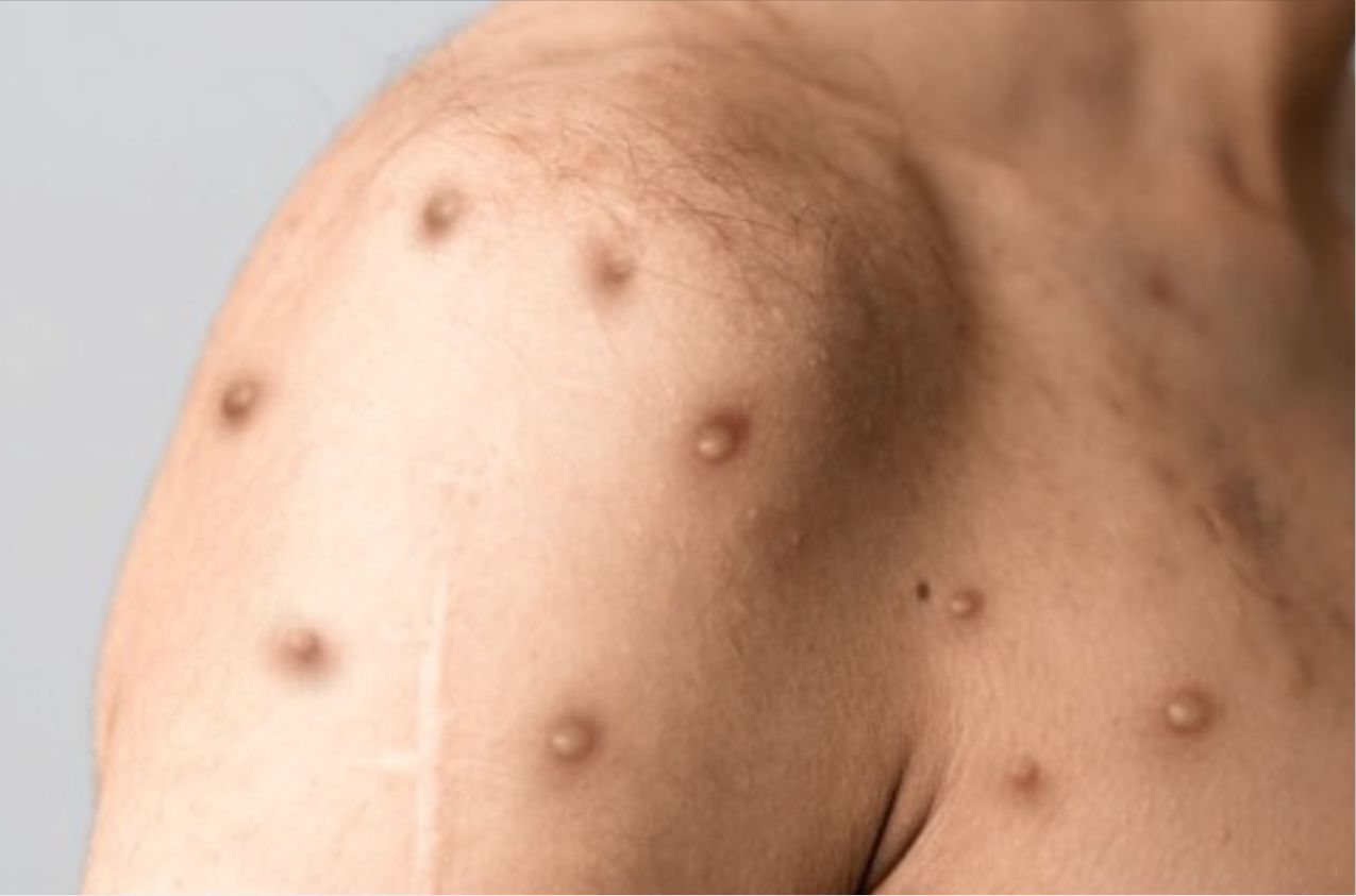 Varíola do Macaco: TV Câmara conversa com a médica Infectologista, Dra. Flávia Trench